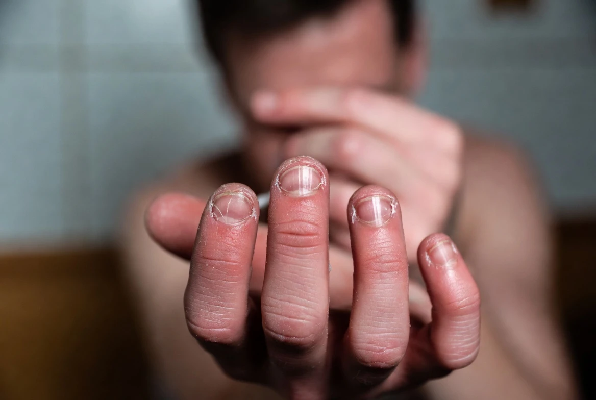 Treatment Approaches for OCD Symptoms